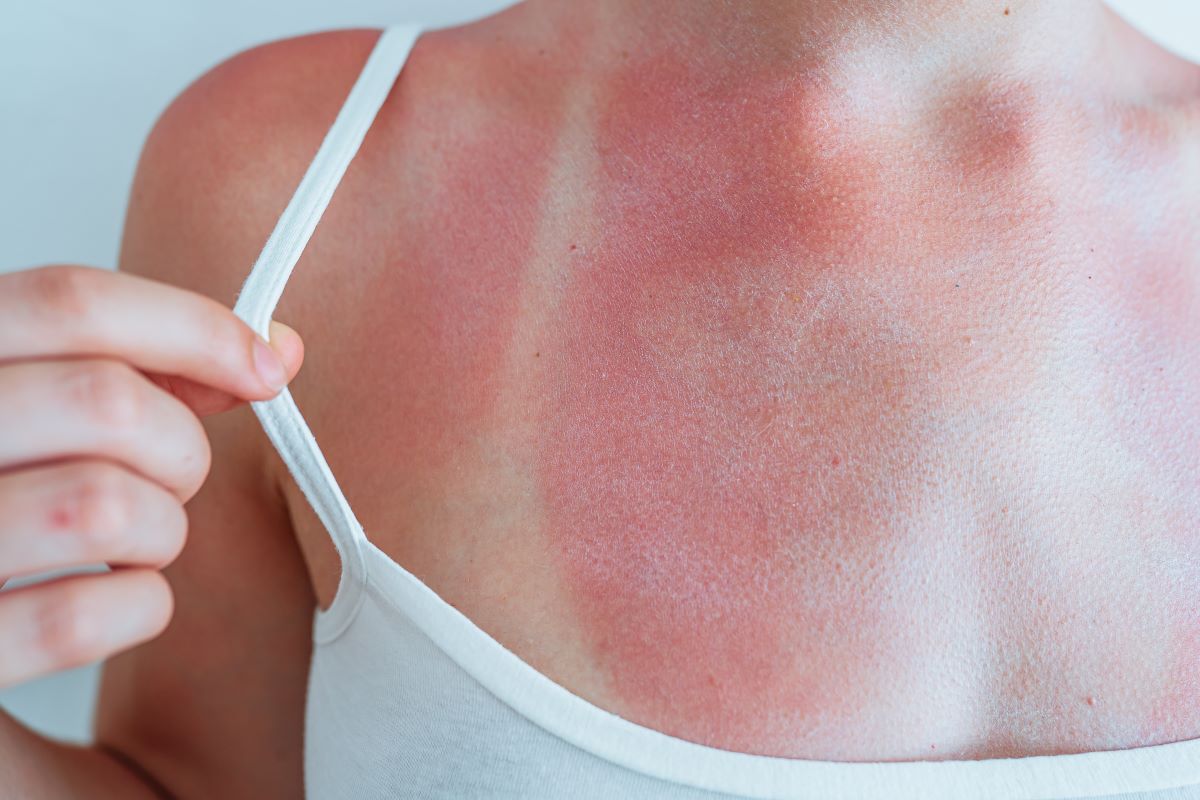Sonnenbrand in Olpe vermeiden und richtig behandeln – Ein Ra